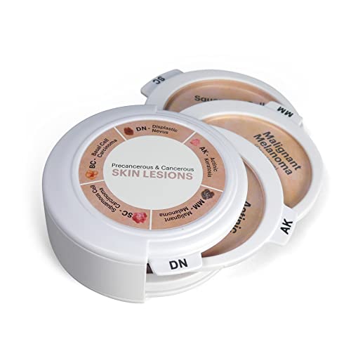 GPI Anatomicals - Skin Cancer Model, Replica with Precancerous and Cancerous Skin Lesions for Human Anatomy and Physiology Education, Anatomy Model for Doctors Office, Medical Learning Resources