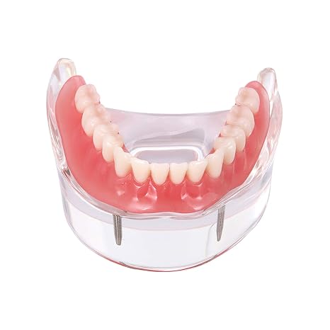 Dental Implant Teeth Demo Model Overdenture Restoration with 2 Implants Model M6002