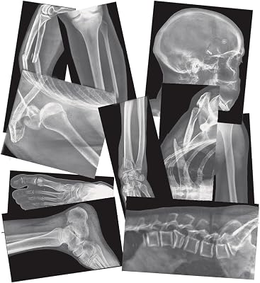 Roylco Broken Bones X-Ray Set, Projector Display Compatible, 15 X-Rays