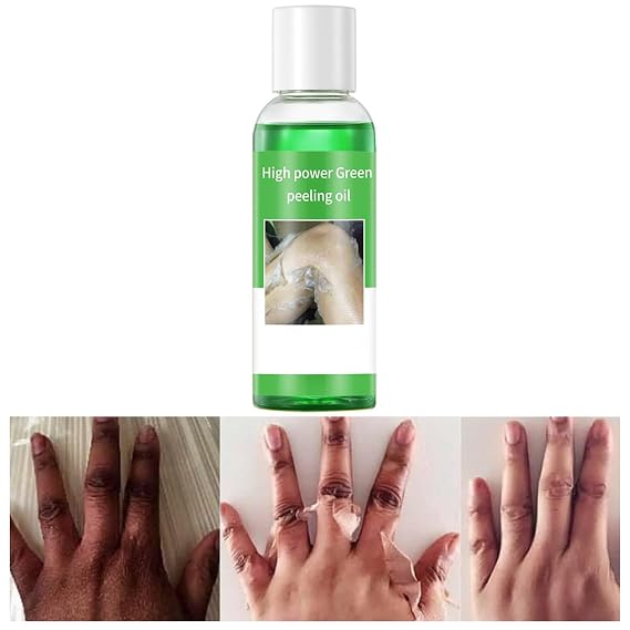 IREV Peeling Oil Dark Skin, Green Peeling Oil, Facial Peeling Oil w/ Hyaluronate,Exfoliating Peeling Solution Body, Chemical Peel At Home Dark Spots, Body Peeling All Skin Type 3.66 OZ